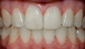 after_no_braces_1.jpg.640x480_q85