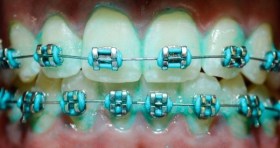 during_with_braces_1.jpg.640x480_q85